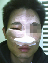 회사 측으로부터 폭행 후 해고당한 비정규직 노동자. 안면골절로 수술을 받았다.<출처; 민중언론 참세상, 지엠대우부평공장 비정규직 제공><br />