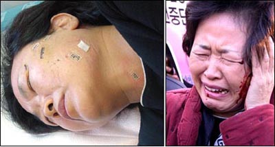 경찰은 조폭만 구타하는가? 시위 도중 경찰폭력에 부상당한 시위참가자